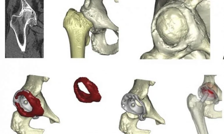 Спасиха крака на млад мъж след 3D операция - Tribune.bg