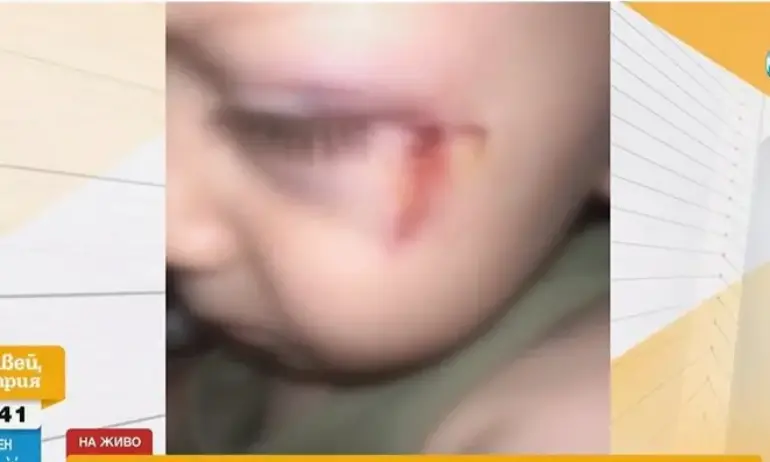 2-годишният Сашко е с шевове на лицето след инцидент в