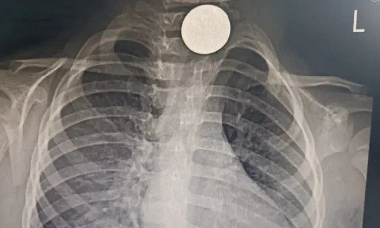 Бургаски лекари спасиха дете, живяло с монета в хранопровода месец и половина - Tribune.bg