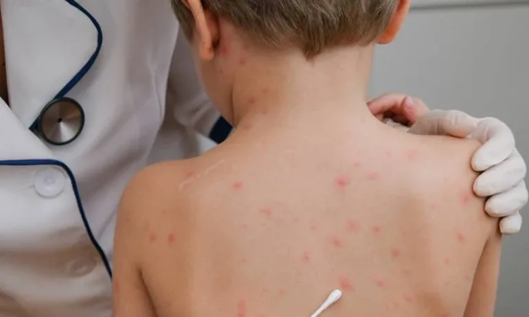 Нови случаи на морбили, засегнати са три области - Tribune.bg