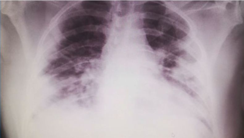 Снимка на белите дробове на пациента, на която се вижда, че има частична загуба на тъкан в органа