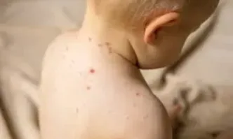 Нови случаи на морбили бяха регистрирани в района на Бяла
