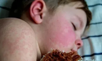 101 случая на морбили у нас, 89% от заболелите са деца